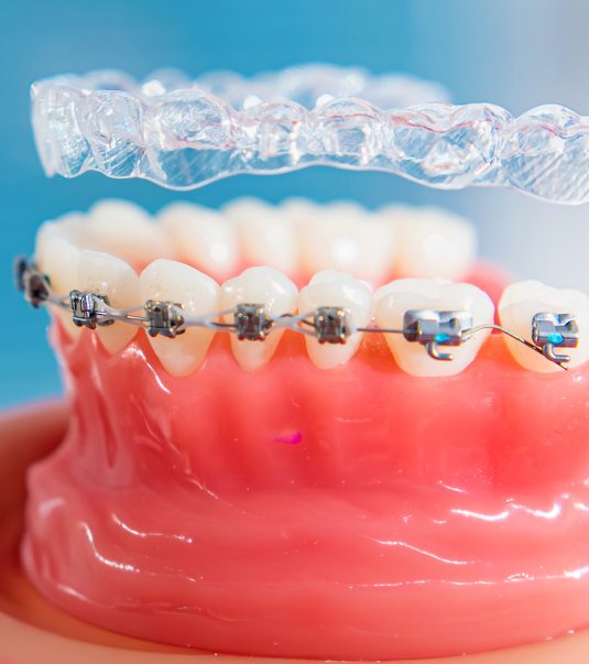alineadores-invisibles-querétaro-invisalign-queretaro-dientes-co-dra-alejandra-dorantes-dentista-en-queretaro